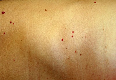 pinpoint red dots on skin turn brown
