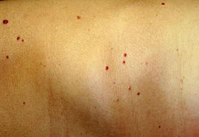 raised pinpoint red dots on skin