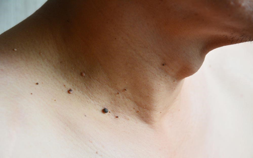 skin tags on neck