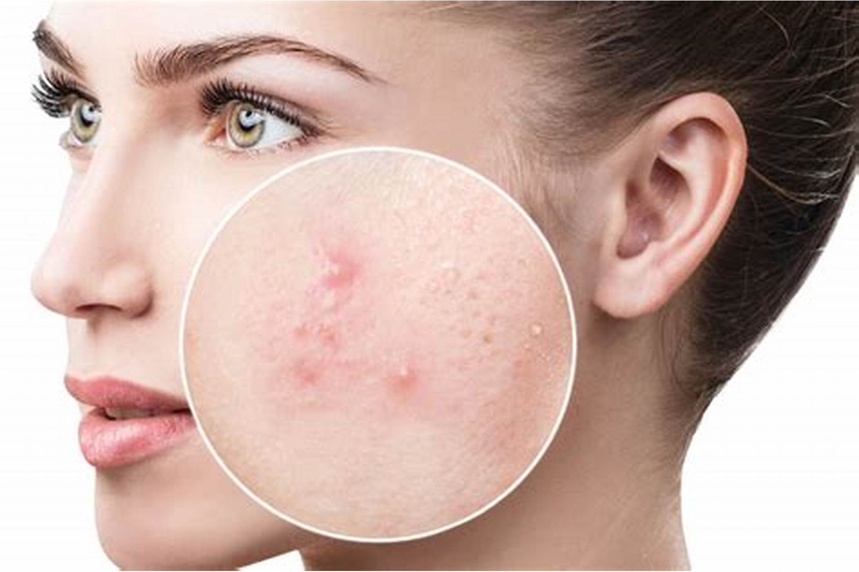 Is popping your pimples bad?